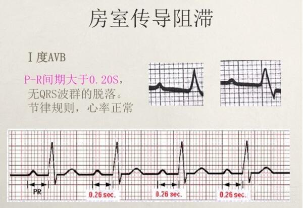 心电图异常怎么办
