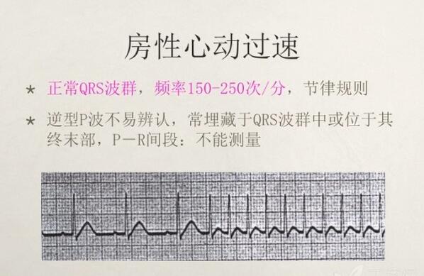 心电图异常怎么办