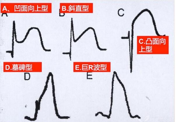 心电图异常怎么办