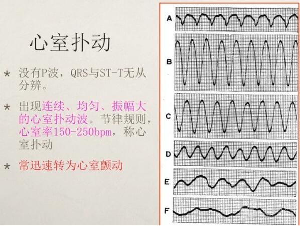 心电图异常怎么办