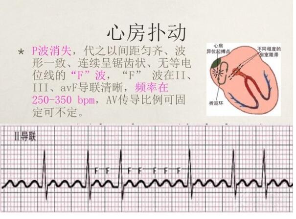 心电图异常怎么办