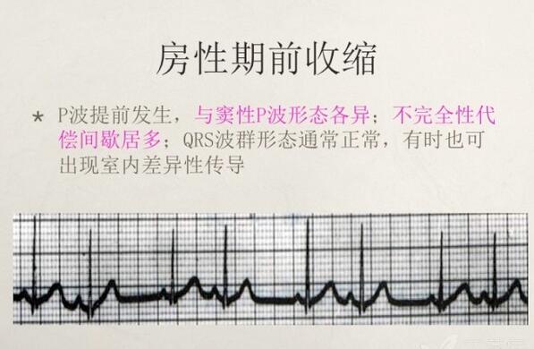 心电图异常怎么办