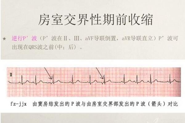 心电图异常怎么办