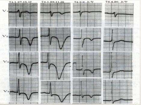 心电图异常怎么办