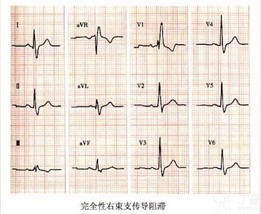 心电图异常怎么办