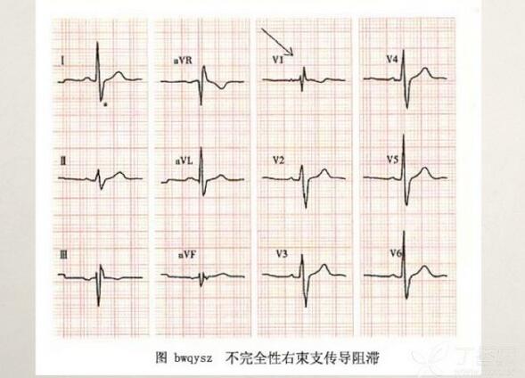 心电图异常怎么办