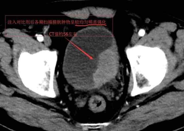 健康 正文  1,手术因素:非肌层浸润浅表性膀胱癌的手术类型多样,无论