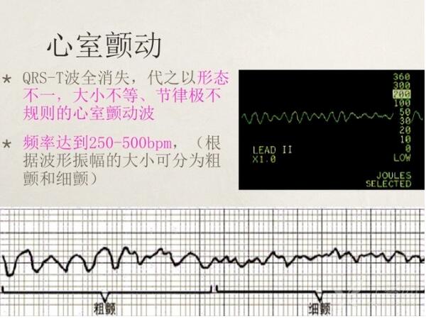 心电图异常怎么办