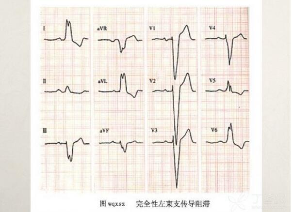 心电图异常怎么办