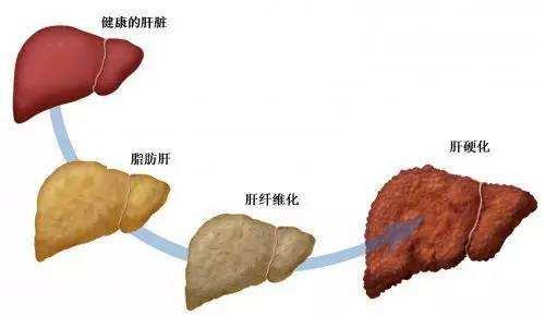 这两个坏习惯比喝酒伤肝多了,很多女性都有