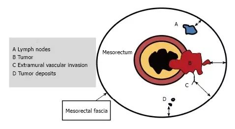 直肠癌 mrl 入门秘籍(多图)
