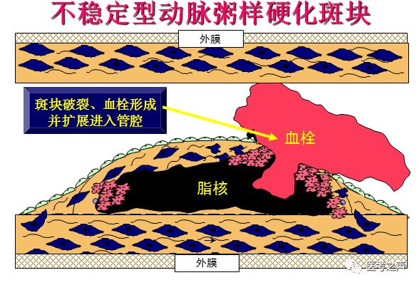 健康 正文 他就比较危险了 斑块随时可能破 所以病情比较急 属于急性