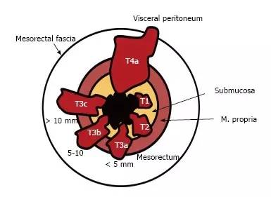 直肠癌 mrl 入门秘籍(多图)