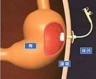 胃造瘘示意图