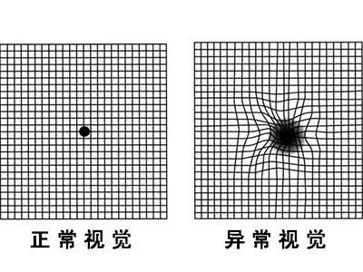 确诊黄斑病变须做oct检查!你的眼睛