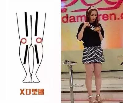 xo型腿怎么穿搭超短裙_xo型腿怎么矫正