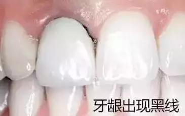 烤瓷牙边缘发黑怎么办