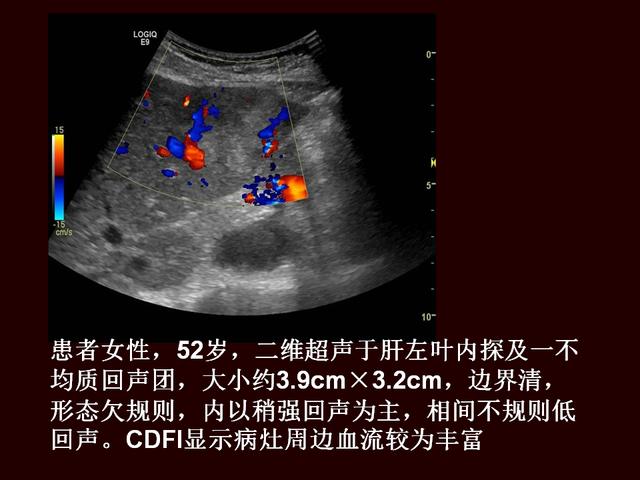 超声造影提高原发性肝癌的诊断灵敏度