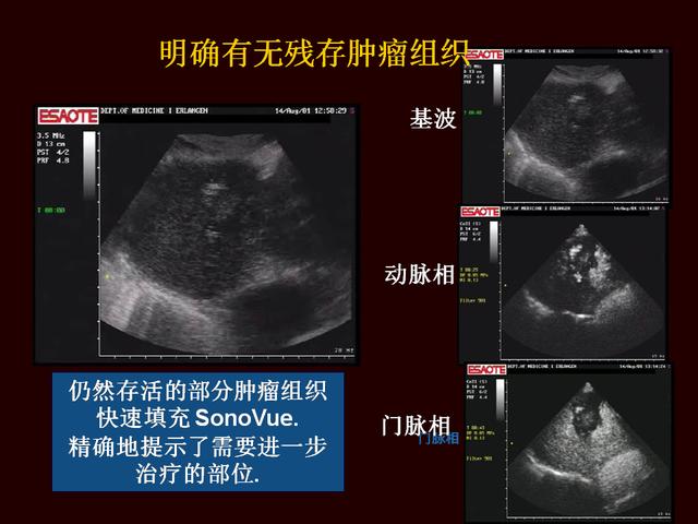 超声造影提高原发性肝癌的诊断灵敏度