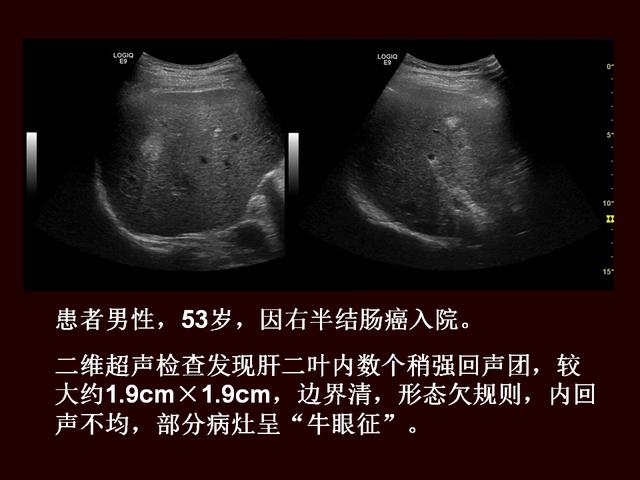 超声造影提高原发性肝癌的诊断灵敏度