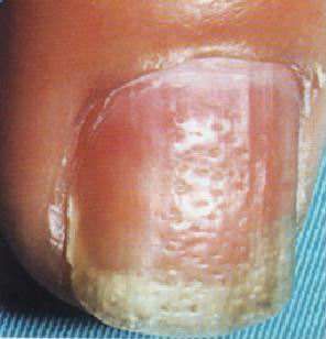 出现了这种现象的指甲往往是银屑病的早期信号,这是一种非常顽固的