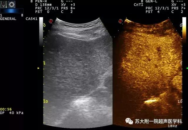 超声造影超声影像诊断的升级版