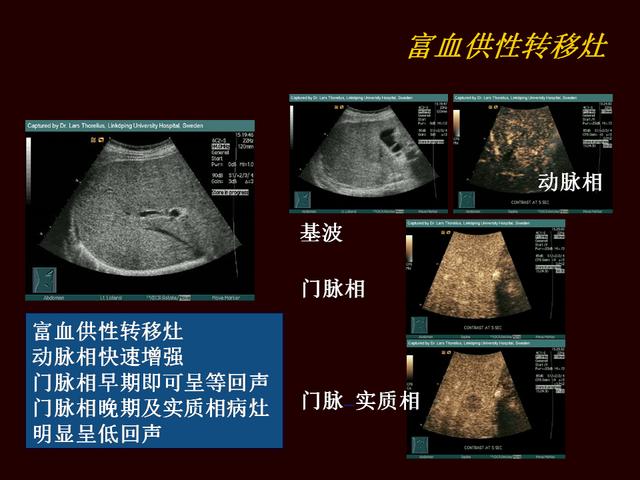 超声造影提高原发性肝癌的诊断灵敏度