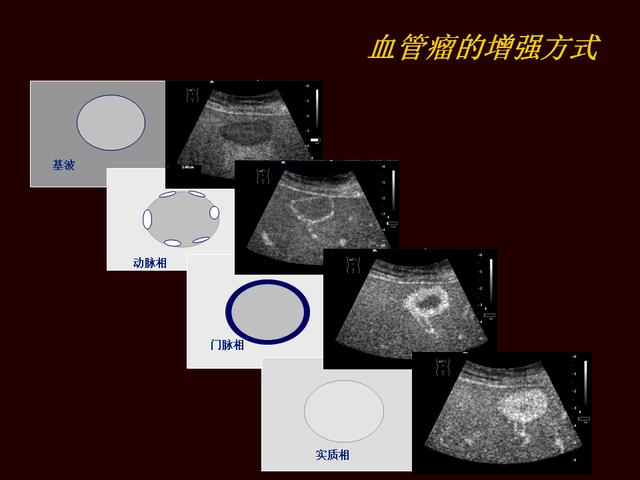 超声造影提高原发性肝癌的诊断灵敏度