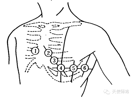心电图导联线的连接如何快速确定位置
