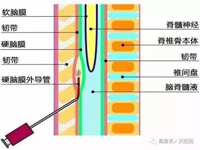 【中国麻醉周】产妇的福音——无痛分娩技术