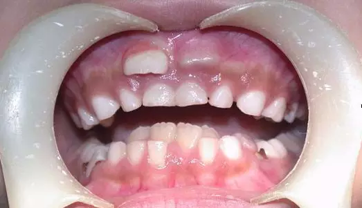 导致部分甚至全部被占据,以至恒牙错位萌出或埋伏阻生而形成牙颌畸形