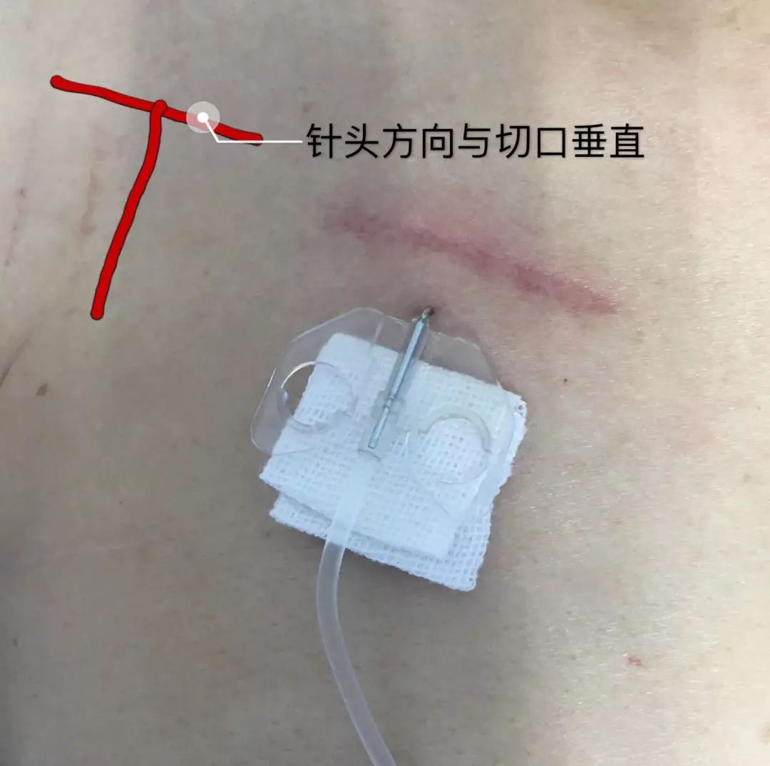 输液港蝶翼针横着扎还是竖着扎