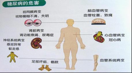 糖尿病发病率持续攀升预防糖尿病已经刻不容缓