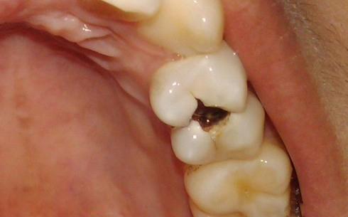 健康 正文 蛀牙(虫牙)并不是牙齿里面真的长了虫子,而是被细菌腐蚀了.