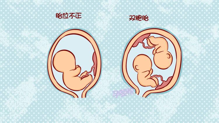 当出现胎儿的胎位不正,比如横位,臀位等情况,孕妈们在孕39周时就应该