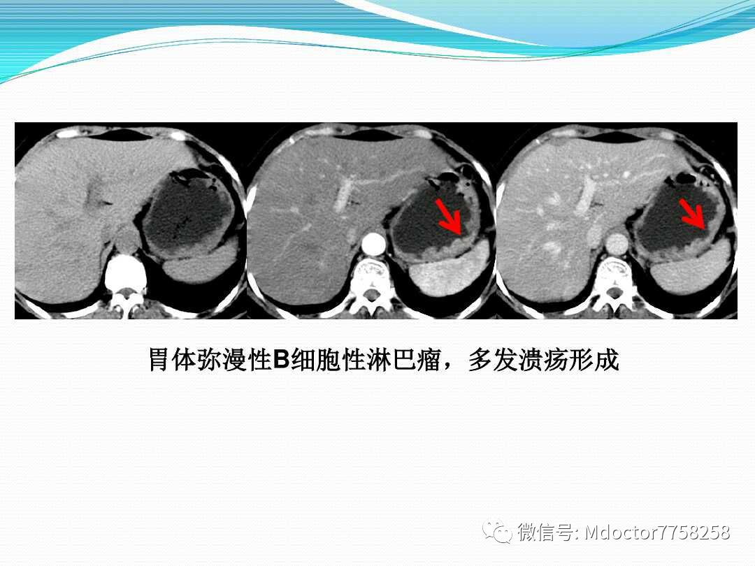 胃壁增厚疾病ct,mri影像表现