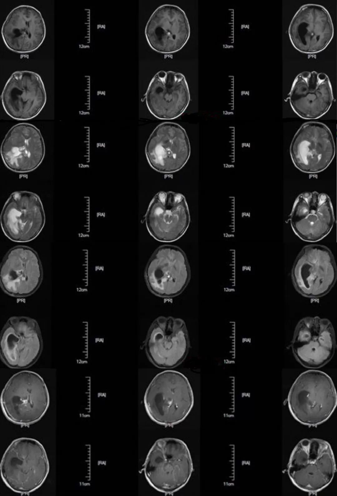 术后第48天患者常规复查头部mri,提示右侧侧脑室颞角,后角扩张并周围