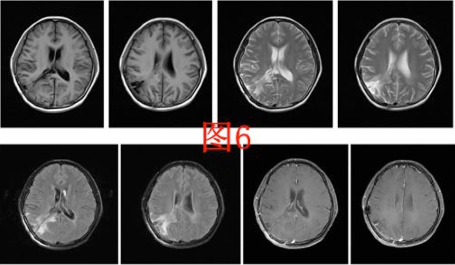 入院后行头部mri(图4)检查提示右侧侧脑室颞角,后角扩张并周围脑组织