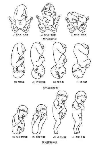 胎位全图:头位分娩属于正常胎位,臀位,横位均属于胎位不正.