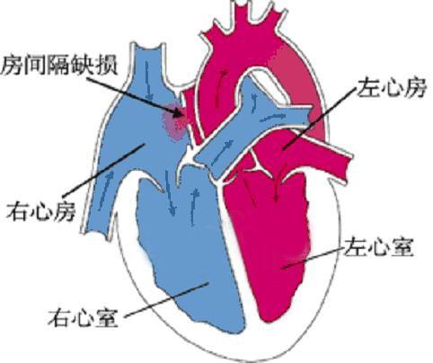 房间隔缺损的3种治疗方法!