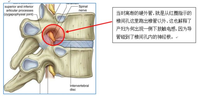 麻醉医生出事了!硬膜外穿刺时,断管残留体内