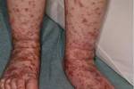 患儿一般情况好,四肢大量红色融合性红色丘疹和出血性疱疹,伴有脱