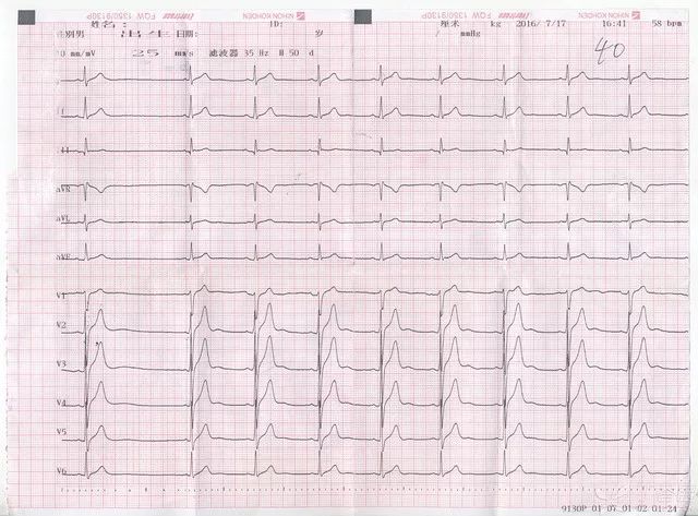 特别有意思的心电图考验你的火眼金睛了