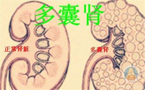 北京华科中西医结合医院解析如何诊断多囊肾