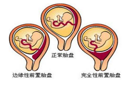 前置胎盘孕妇生产,其风险可达"极危级别",常常会出现大出血而不得不