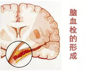 血压低的原理是什么_血压低是什么原因(2)