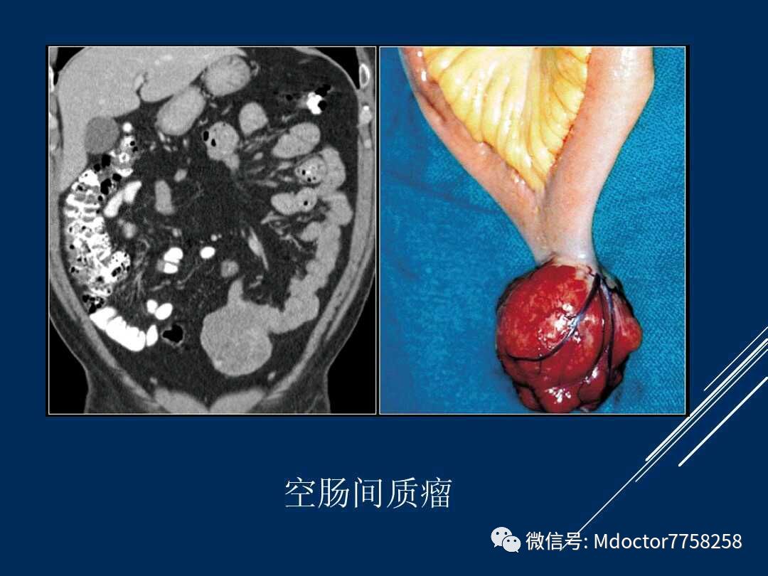 胃肠道间质瘤影像诊断视频学习