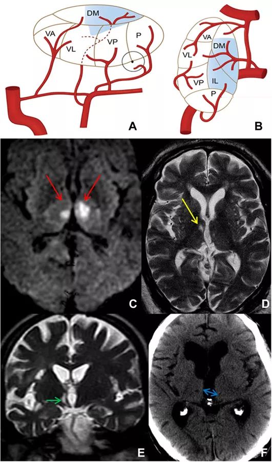 丘脑旁正中动脉供血示意图和梗死影像学表现