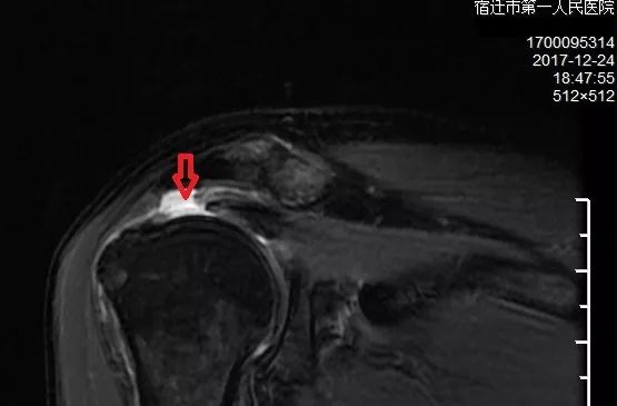 磁共振显示肩袖撕裂
