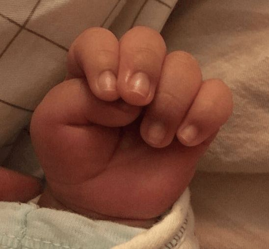 比如大拇指内扣,新生儿五个手指通常是手握空心拳,也有一部分会宝宝将
